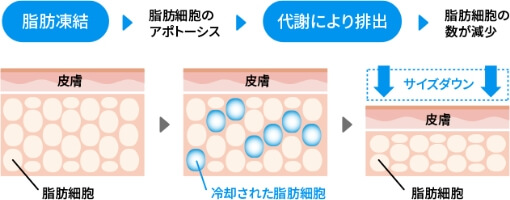 先進的な医療機器を使った脂肪燃焼・脂肪細胞の破壊