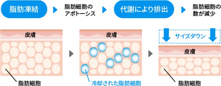 脂肪冷却の効果の画像