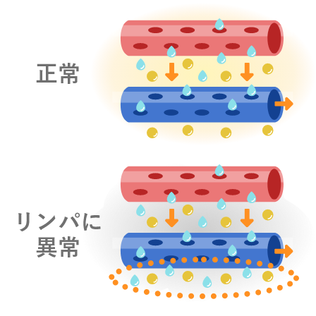 画像：リンパ管の流れが滞ると、静脈から排出されたリンパ液をリンパ管が吸収できず周囲にリンパ液が漏れ出し、脂肪細胞の栄養となる
