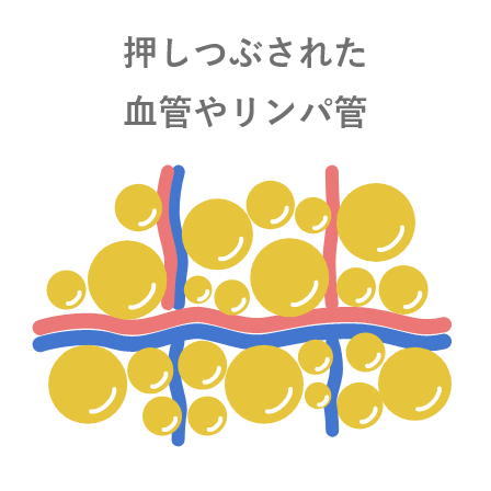 画像：脂肪細胞のまわりの血管やリンパ管が押しつぶされ、流れが悪くなり代謝が悪化