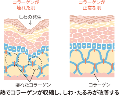 高周波エネルギーでお尻の老廃物を排出02