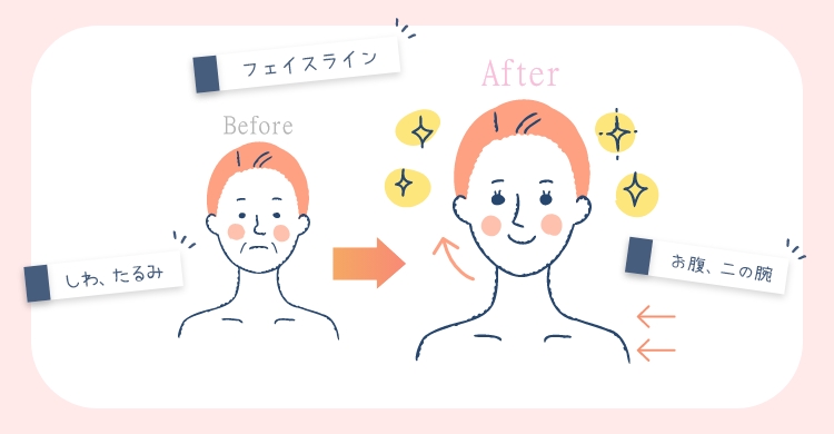 ハイフの効果