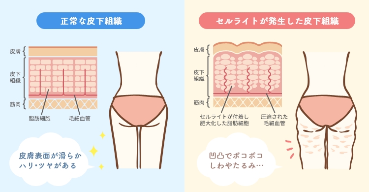 セルライトとは